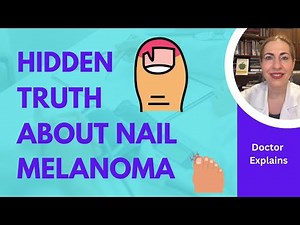 NAIL Melanoma ALERT What You MUST Know! Doctor Explains