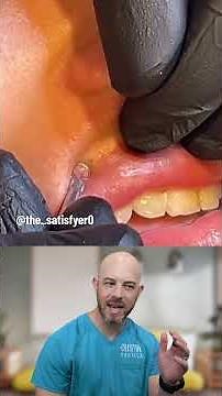 These lip blackhead POPS are all the rage! (credit: @the_satisfyer on TT) #skincare #blackheads