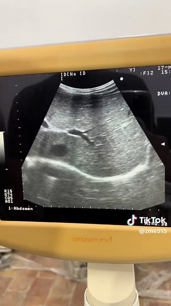 Aloka ProSound 6 Convex Probe Ultrasound Machine