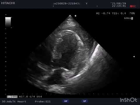 Case 265: PEA Arrest with Clotted Hemopericardium – Pericardiocentesis Failure