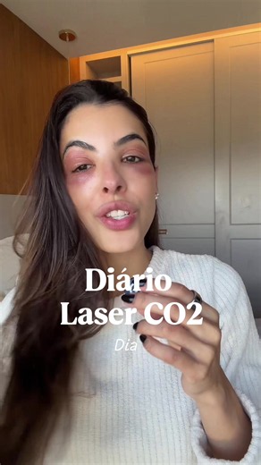 Já me segue para acompanhar essa saga ➡️ #laserco2 #laserfacial #linhasfinas