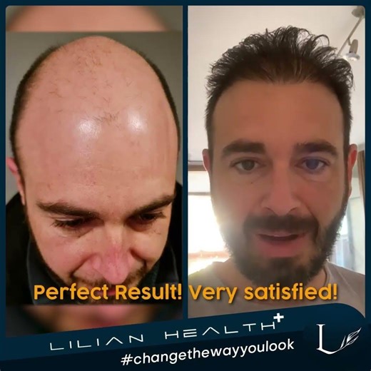 3 Italian Patients • Real Hair Results (Thank You) #shorts