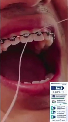 Uso de hilo dental Superfloss de Oral-B en brackets #shorts #brackets #superfloss #oralb
