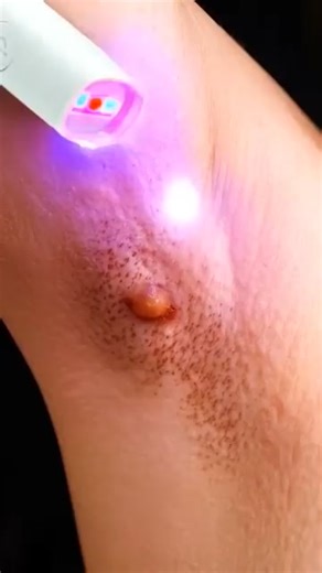 This gentle laser pen enhances skin appearance and is perfect for daily at-home beauty care, leaving skin smoother and more refined. ✨ Why choose our laser pen? 🌱 Non-invasive & gentle on skin 💡 Visibly improves skin tone and texture 🌟 Easy to use in your daily skincare routine ✨ Reveals smoother, clearer skin and boosts confidence | Balanced nutrition health