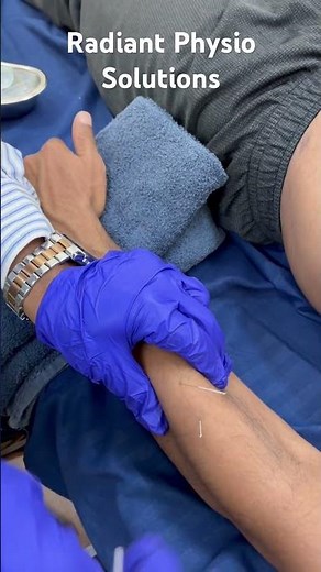 Dry needling for tennis elbow #physiotherapist #dryneedling #tenniselbowtreatment #accupuncture