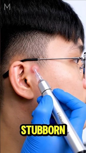 This "Blackhead" Was a HIDDEN VOLCANO About to Erupt on His Glasses!