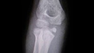 Surgical treatment of a neglected medial epicondyle fracture, interposed into ulno-humeral joint, in an 11 years old patient