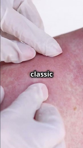 Symptom Analysis - "Unveiling Lupus: Hidden Symptoms and Early Warning Signs!"