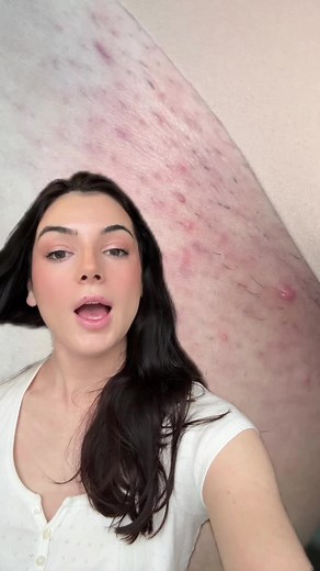 Best Bikini Line Shaving Routine to Prevent Razor Bumps and Ingrown Hairs