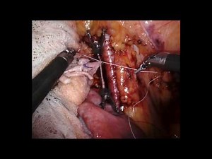 Robotic Kidney Transplant - Step-by-Step  • Video • MEDtube.net