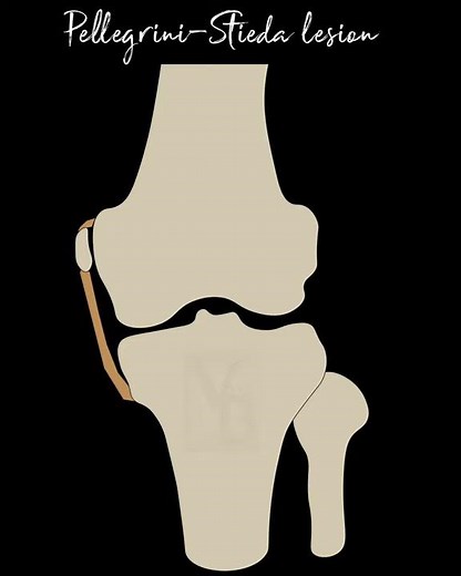 Pellegrini-Stieda lesion