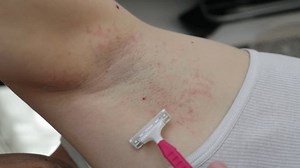 Armpit Allergy Young Man Shows Scratches Stock Footage Video (100% Royalty-free) 3701355725 | Shutterstock