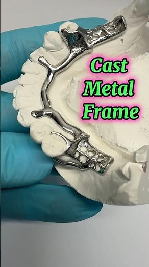 Cast Metal Frame for Partial Denture #dentures #removabledenture #missingteeth