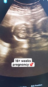 18 weeks pregnancy 💞 #reelsviralシ #drnusratislam #viralreelsシ | Dr. Nusrat Islam