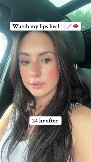 Juvederm Lip Filler Journey: Healing Timeline