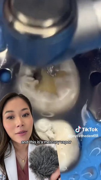 Dentistry Explained episode 16494040 | Watch the drilling of a silver filling. These need to be suctioned up to prevent patients from swallowing silver particles. #silverfillings #amalgam #dentist