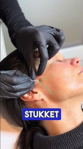 Profhilo Structura Step-by-step hos Nueli Medical Spa