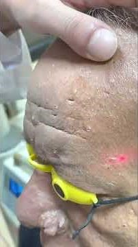Sebaceous hyperplasia laser removal