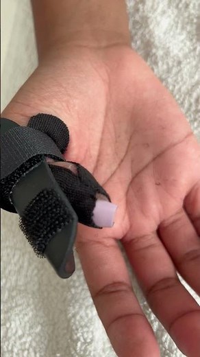 👍 Thumb Fracture? Support = Movement, Not Immobilisation