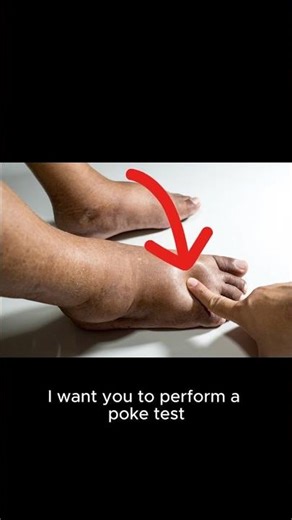 Not All Ankle Swelling Is the Same