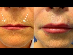 How to Get Rid of Wrinkles around Lips💋How to Get Plump Lips/Bigger/Lips/Fuller Lips