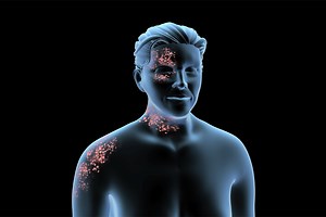 Postherpetic Neuralgia Treatment by Pain Medicine Specialists in Baltimore, MD - Mercy