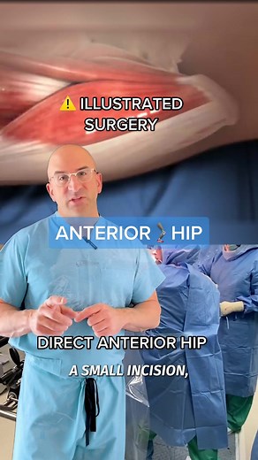 Direct anterior approach is a minimally invasive way to perform #hipreplacement surgery. The incision for the #directanterior approach is approximately 3-4 inches. Advantages some patients see with anterior hip replacement include going home sooner, less pain, and reaching early therapy milestones more quickly. The direct anterior method is considered a “muscle sparing” technique because it does not involve cutting into (and later repairing) muscles and tendons to reach the damaged #hipjoint. In