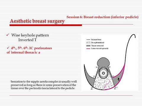 Aesthetic breast surgery inferior pedicle. Ahmed Ali Hassan, MD