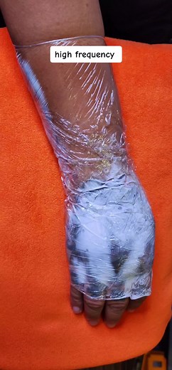 Options...... if hinde naman nag mamadali step by step session standard frequency po iwas peklat. if nag mamadali naman po pwede high frequency pero susugat pwede mag peklat/keloid less session #picowaylaser #lasertattooremoval #tattooremoval #triskelion #taugamma #pogi #idol #astig #fyp #fyp #dreadlocks