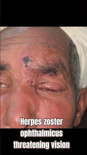 Herpes zoster ophthalmicus threatening vision.