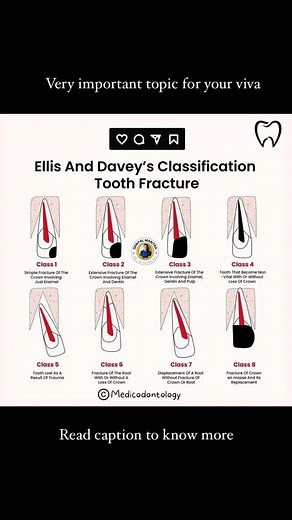 Dr. Aakanksha Raj 🎯📚🦷 on Instagram: "Ellis and Davey’s classification is a system used to classify tooth fractures based on the severity of damage to the tooth structure and surrounding tissues. It is commonly used in dental trauma cases. Ellis and Davey’s Classification of Tooth Fractures 1. Class I – Enamel fracture • Involves only the enamel without exposure of the dentin. • No pain or sensitivity. • Usually presents as a small chip or rough edge. 2. Class II – Enamel and dentin fracture •