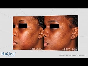 NeoClear by Aerolase Laser Acne Therapy