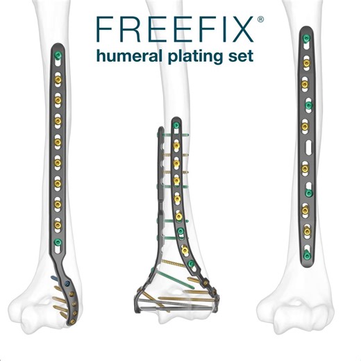 FREEFIX® Humeral Plating Set – TiBeam® technology connects the medial and lateral plates to allow for compression across the trochlea. https://skeletaldynamics.com/freefix-humeral-plating-set/ | Skeletal Dynamics