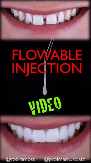 Prof. Dr. Markus B. Blatz on Instagram: "FLOWABLE INJECTION TECHNIQUE -case example with video…. Great collaboration with @robramoss Have a superb day!!!! #dentistry #dentist #dental #estheticdentistry #dentaleducation #dentalresearch #cosmeticdentistry #restorativedentistry #flowablecomposite #flowableinjectiontechnique"