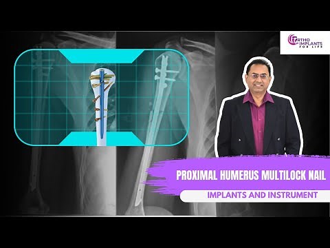 Proximal Humerus Multilock Nail Implants and Instruments