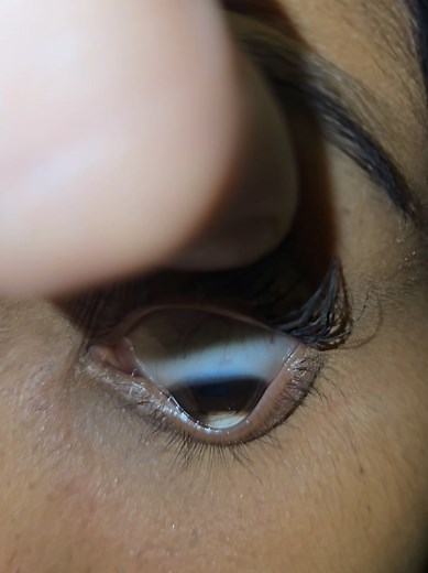 Tratamiento del Queratocono: Salud Ocular Esencial