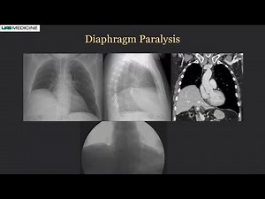 Quantifying Diaphragm Motion | Satinder P. Singh MD, FCCP, FNASCI, FSABI | Konica Minolta Healthcare