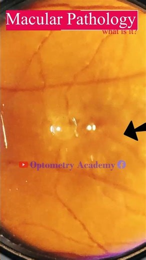 Macular Pathology | Diabetic retinopathy | Fundus Photography | Short Video 444