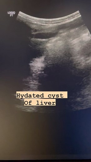 21 reactions · 4 comments | Hydated cyst of liver #hydatedcyst #liver #livercyst #hepaticcyst #liverdisease #ultrasoundmadeeasy #radiologist #ultrasonography | Ultrasound made easy | Facebook