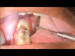 Closed Extraction of Partially impacted lower wisdom