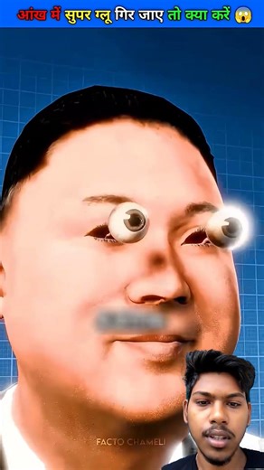 Accidentally Got Super Glue in Your Eye What to Do 😱🤯