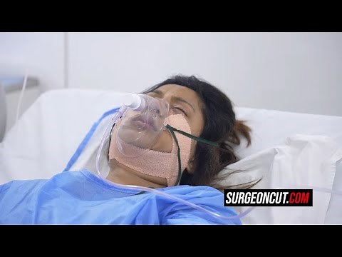 Orthognathic Double jaw Surgery for Indian girl (before and after) Behind scenes | Dr. Richardson