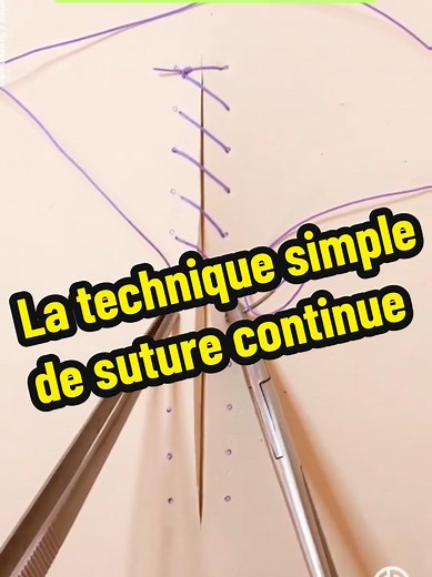 Technique de Suture Continue : Guide Pratique et Simple