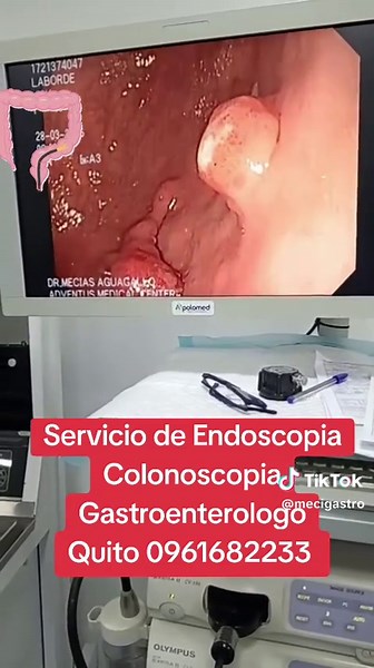 Endoscopia con Pólipos: Biopsia y Extracción