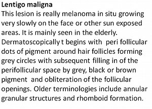 Lentigo maligna