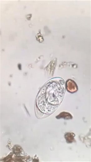 Analis Laboratorium Medik | Temuan mikroskop yang sangat langka: Telur Strongyloides stercoralis. Kenapa langka? Karena biasanya telur ini sudah menetas menjadi larva... | Instagram