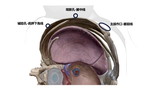 看懂手术（1）- VATS肺叶手术-秒看懂！