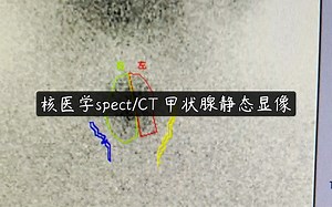 核医学spect/CT 甲状腺静态显像