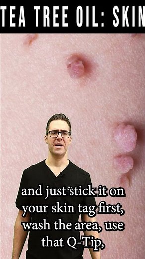 Skin Tag Removal & Wart Removal [Tea Tree Oil Natural Remedy]