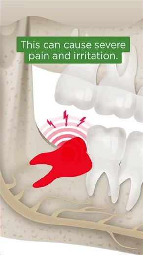 FAQ: What is Dry Socket?
